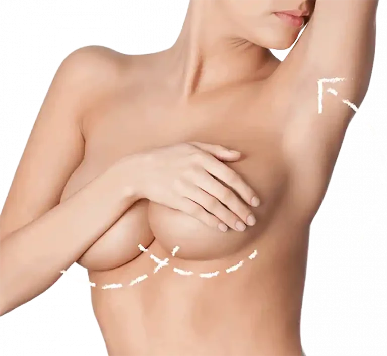 Endoskopische Brustvergrößerungen in München werden bei Breastetics durchgeführt